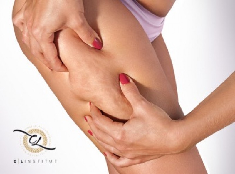 Quels sont les différents traitements possibles selon le type de cellulite ?